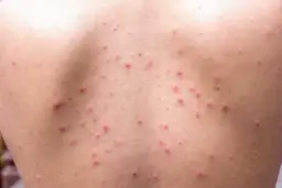 Pryszcze na plecach: Co je powoduje i jak raz na zawsze się ich pozbyć?