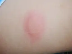 Bolesne gule pod skórą: Szybkie sposoby leczenia i zapobiegania