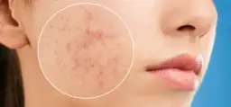 Trądzik u dorosłych? Kompleksowy poradnik: pielęgnacja, dieta, leczenie