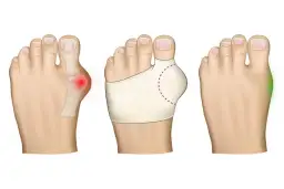 Ilustracja trzech stóp: z haluksem, z opaską korygującą i zdrowa.