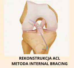 Rekonstrukcja ACL prywatnie czy na NFZ – co wybrać, by uniknąć błędów i kosztów?