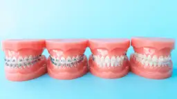 Ile kosztuje aparat na zęby na noc? Ceny i ważne informacje