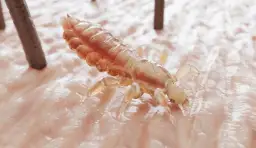 Pasożyty w głowie: 5 niepokojących objawów u dorosłych