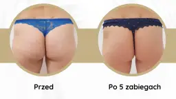 Elektrostymulacja czy endermologia – która metoda naprawdę działa?