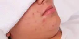 Zbliżenie na twarz z licznymi podskórnymi pryszczami i zaczerwienieniami.