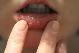 Rak jamy ustnej jak wygląda - objawy, które mogą zaskoczyć