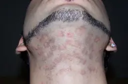 Czy można wyrywać włosy po depilacji laserowej? Skutki, które musisz znać