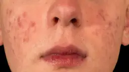 Skuteczne sposoby na wybielanie czerwonych plam po pryszczach