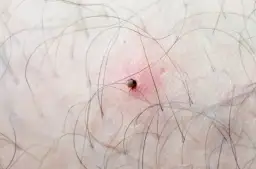 Nimfa kleszcza: Dlaczego jest groźniejsza? Rozpoznaj i usuń!