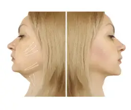 Ile kosztuje liposukcja podbródka? Ceny i ukryte wydatki, które musisz znać