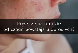 Zbliżenie na skórę z pryszczami na brodzie i policzku.