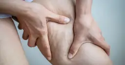 Jak pozbyć się cellulitu z ud? Domowe sposoby i zabiegi