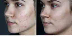 Blizny i przebarwienia po trądziku: Domowe sposoby, które działają?