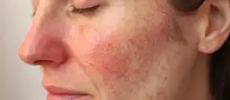 Skóra z widocznym zaczerwienieniem i porami. Szukasz sposobu, jak zmniejszyć zaczerwienienie pryszcza?