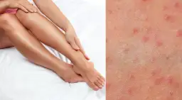 Gładka skóra bez podrażnień po goleniu? Mój sekret na krostki