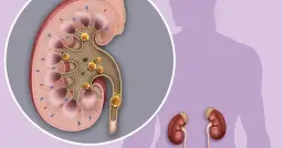 Jak długo trwa ból nerek po alkoholu? Objawy i co robić, by ulżyć