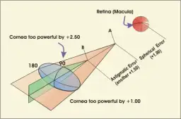 Cylindry w soczewkach: co to jest i jak poprawiają wzrok?