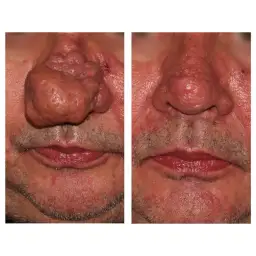 Skuteczne sposoby na pozbycie się pryszcza w nosie bez bólu