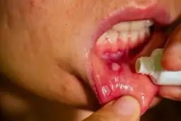 Nadżerki w ustach: domowe sposoby, leki i dieta szybka ulga