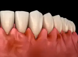 Co na zapalenie dziąseł? Skuteczne metody leczenia i profilaktyki