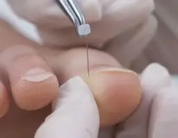 Jak długo nosić klamry na wrastające paznokcie? Czas leczenia i oczekiwania