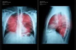 Najważniejsze objawy raka płuc: pierwsze niepokojące sygnały choroby