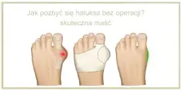 Bolące haluksy: Szybka ulga i skuteczne leczenie co działa?
