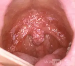 Grzybica jamy ustnej: Czy zaraża bliskich? Prawda o kandydozie.