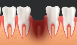 Ile goi się dziąsło? Czas gojenia, porady i jak uniknąć suchego zębodołu