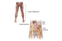 Przyczyny rwy kulszowej: co może wywołać ten bolesny stan?