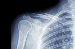 Ile trwa rehabilitacja po złamaniu obojczyka i co wpływa na czas?