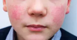 Na policzkach dziecka widoczny jest rumień, skóra jest zaczerwieniona i lekko łuszcząca się.