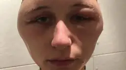 Uczulenie na ogórki kiszone objawy – jak je rozpoznać i unikać