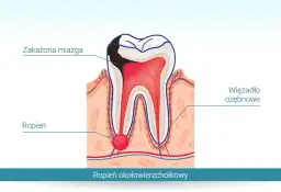 Co na ropę w dziąśle? Skuteczne sposoby na ulgę i leczenie