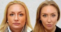 Botoks na bruksizm: Ile jednostek? Koszt, efekty, zabieg