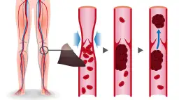 Zaburzenia krzepnięcia krwi objawy - jak je rozpoznać i leczyć