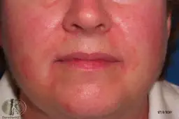 Rote Flecken im Gesicht: Ursachen, Behandlung & Soforthilfe