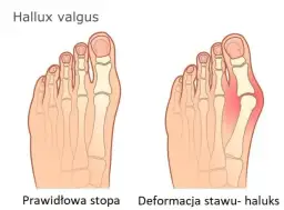 Jak bolą haluksy? Rozpoznaj objawy i wiedz, kiedy działać!