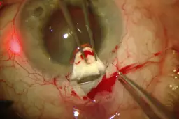 Zbliżenie na oko podczas operacji jaskry, widoczne narzędzia chirurgiczne i krew.