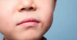 Dziecko z opryszczką w przedszkolu? Kiedy bezpieczny powrót?