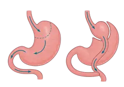 Operacja sleeve to Twoja droga do trwałej redukcji masy ciała?