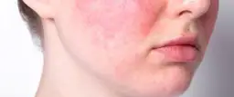 Trądzik różowaty: Skuteczne leki na receptę i bez. Poradnik.