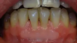 Dlaczego dziąsła się cofają i jak temu zapobiec - poznaj przyczyny