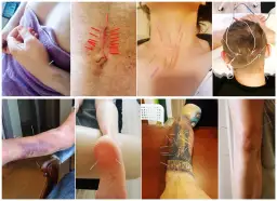 Akupunktura Poznań: Ile kosztuje? Pełny cennik i porady