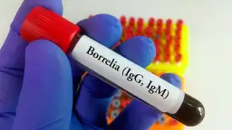 Jak przygotować się do badania na boreliozę, aby uniknąć błędów