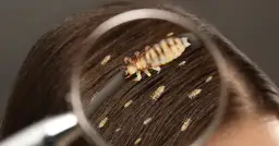 Czy dziecko z wszami może chodzić do przedszkola? Ważne informacje