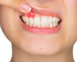 Bolesna afta na dziąśle? Poznaj przyczyny i szybko się jej pozbądź