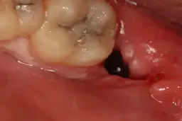 Co w zębodole po wyrwaniu zęba? Tajemnice gojenia i Twoja rola.