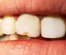 Ukruszony ząb: Koszt naprawy, metody i jak wybrać najlepszą?