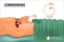 Po wyjęciu cewnika: objawy, zalecenia i kiedy iść do lekarza